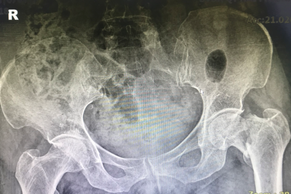 Bệnh nhân 77 tuổi gãy xương nặng được cứu sống tại Bệnh viện Đa khoa Quốc tế Hải Phòng – Vĩnh Bảo