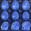 4 giờ phẫu thuật căng thẳng lấy khối u não “khổng lồ” chiếm 1/4 não bộ