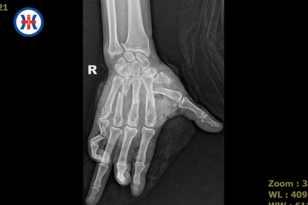 Cứu sống thành công bàn tay bị tai nạn dập nát tưởng chừng phải cắt bỏ