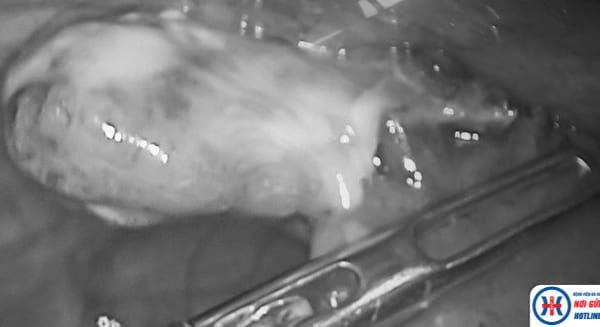 KHOA NỘI: Cấp cứu kịp thời trường hợp Phù phổi cấp – Suy hô hấp cấp/Shock nhiễm trùng do viêm ruột thừa đến muộn