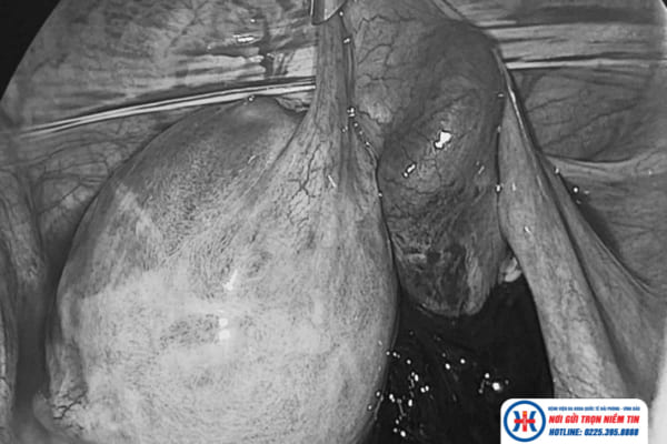 Phẫu thuật cấp cứu trong đêm thành công cho bệnh nhân nguy kịch do khối chửa ngoài tử cung phải chảy máu