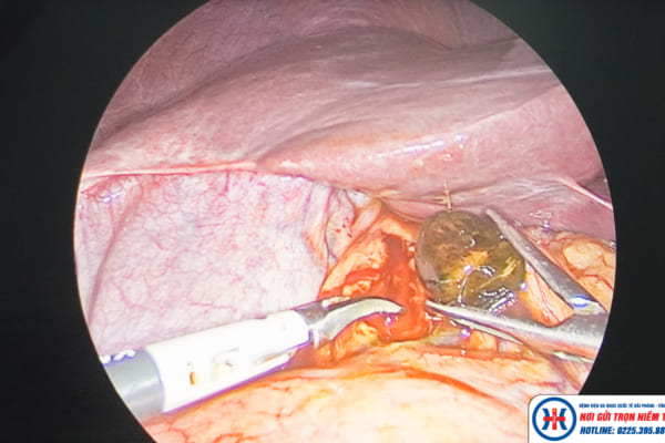 Sỏi đường mật là gì?