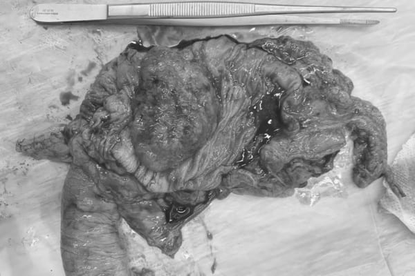 Ung thư đại trực tràng, Tiến triển và biến chứng?