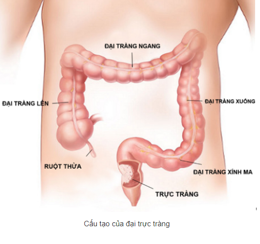 3. Chẩn Đoán Ung Thư Đại Tràng Bị Vỡ