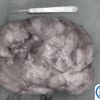 Khoa Ngoại: Phẫu thuật thành công cắt bỏ khối u mỡ vùng đùi có kích thước “khổng lồ”