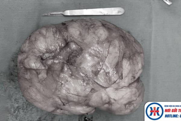 Khoa Ngoại: Phẫu thuật thành công cắt bỏ khối u mỡ vùng đùi có kích thước “khổng lồ”