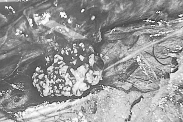 Sỏi tiết niệu và các phương pháp điều trị