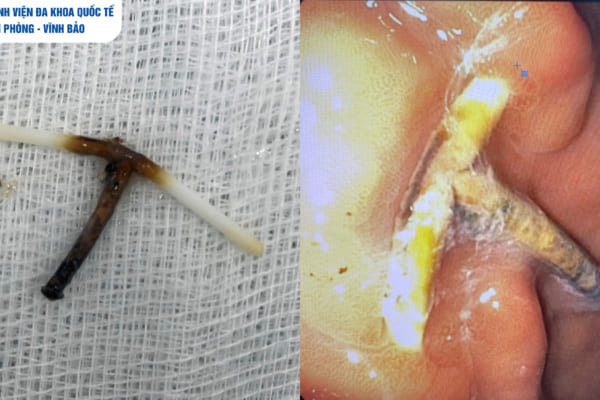 Hi hữu: Dụng cụ tránh thai lạc chỗ, đâm xuyên thành dạ dày người bệnh