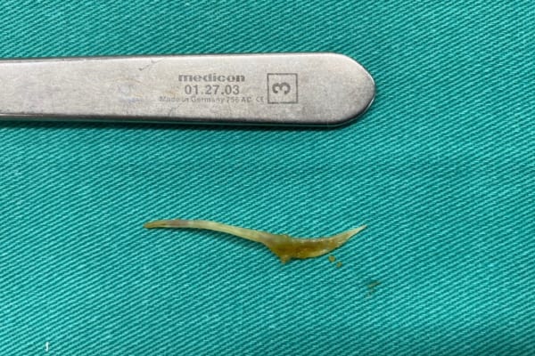 BỆNH VIỆN ĐA KHOA QUỐC TẾ HẢI  PHÒNG – VĨNH BẢO PHẪU THUẬT NỘI SOI THÀNH CÔNG BỆNH NHÂN THỦNG RUỘT NON, VIÊM PHÚC MẠC DO NUỐT PHẢI XƯƠNG CÁ DÀI 4CM