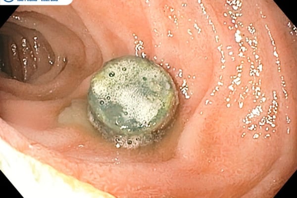 NỘI SOI CAN THIỆP GẮP DỊ VẬT THÀNH CÔNG CHO BỆNH NHI 4 TUỔI NUỐT NHẦM PIN CÚC ÁO