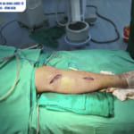 Phẫu thuật xương bằng phương pháp hiện đại -phương pháp mổ Mipo tại Bệnh viện Đa khoa quốc tế Hải Phòng – Vĩnh Bảo