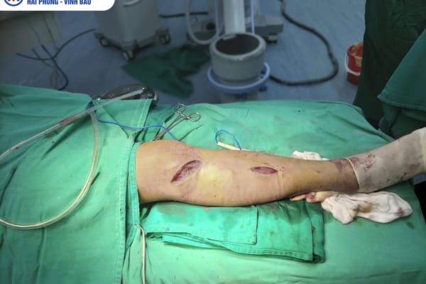 Phẫu thuật xương bằng phương pháp hiện đại -phương pháp mổ Mipo tại Bệnh viện Đa khoa quốc tế Hải Phòng – Vĩnh Bảo