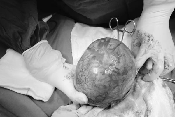 PHẪU THUẬT CẮT BỎ THÀNH CÔNG KHỐI U XƠ TỬ CUNG LỚN BIẾN CHỨNG CHÈN ÉP RỐI LOẠN TIỂU TIỆN, CƯỜNG KINH