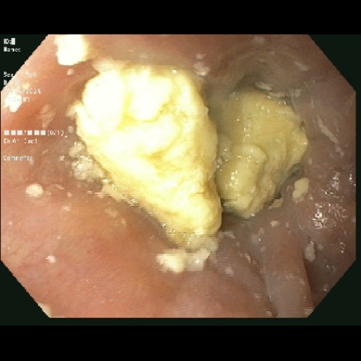 Hình ảnh khối bã thức ăn lớn “mắc” ở đoạn 1/3 dưới thực quản