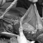 Cứu sống thành công thai nhi của sản phụ mắc dây rau bám màng – Hiện tượng hiếm gặp trong sản phụ khoa