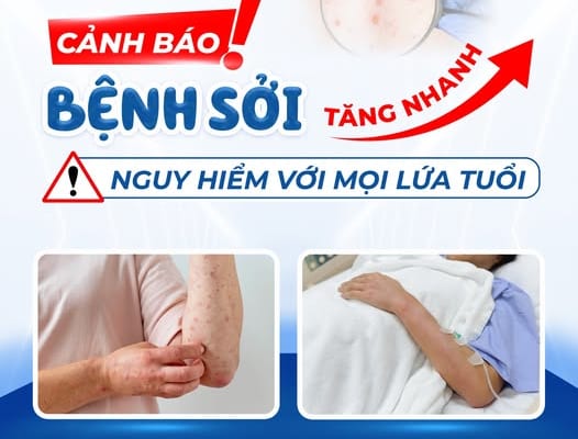 Cảnh bảo: Bệnh Sởi tăng nhanh – Nguy hiểm với mọi lứa tuổi