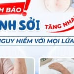 Cảnh bảo: Bệnh Sởi tăng nhanh – Nguy hiểm với mọi lứa tuổi