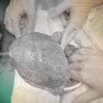 Cắt tử cung khẩn cấp – Cứu bệnh nhân khỏi nguy cơ thiếu máu nặng do u xơ tử cung to như thai 4 tháng biến chứng