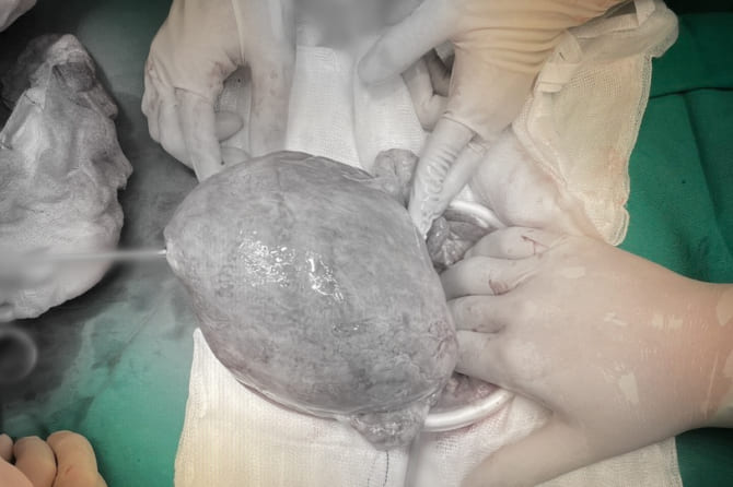 Cắt tử cung khẩn cấp – Cứu bệnh nhân khỏi nguy cơ thiếu máu nặng do u xơ tử cung to như thai 4 tháng biến chứng