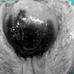 Cấp cứu kịp thời cứu sống bệnh nhân polyp buồng tử cung to gây cường kinh, thiếu máu nặng