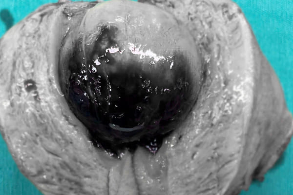 Cấp cứu kịp thời cứu sống bệnh nhân polyp buồng tử cung to gây cường kinh, thiếu máu nặng